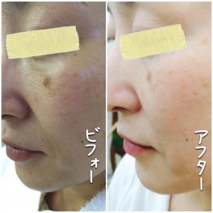 1か月のご使用で驚きの結果♪⌒ヽ(*゜O゜)ノ スゴイッ!!!